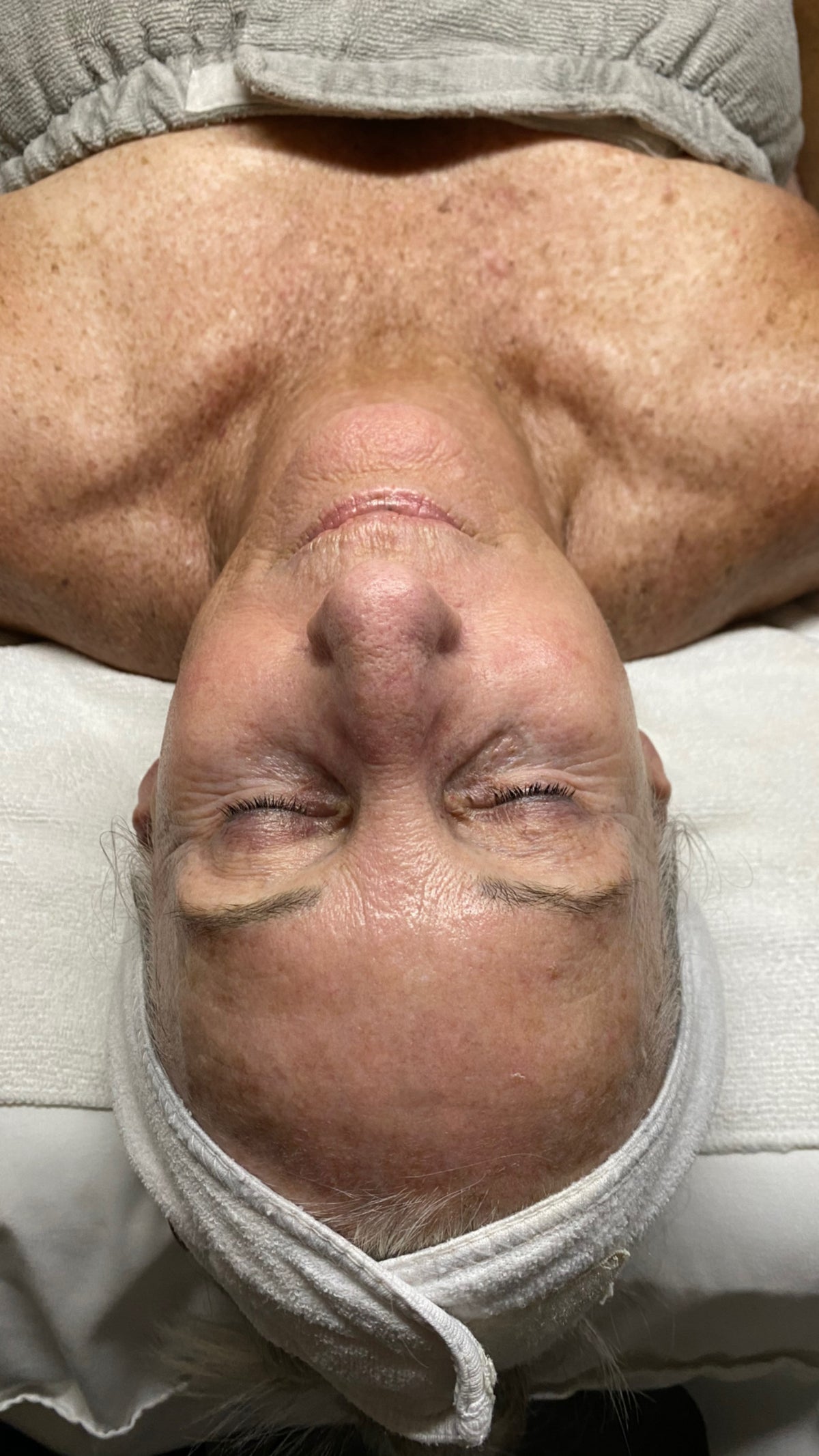 Before treatment image